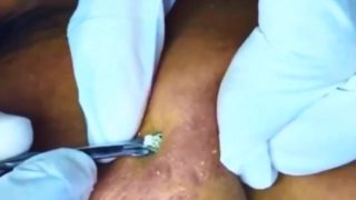 Best pimple popping video 2019