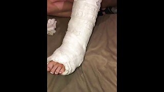 Removing her Soft Leg Cast For The First Time To Reveal Her 21 Staples To Her Broken Leg