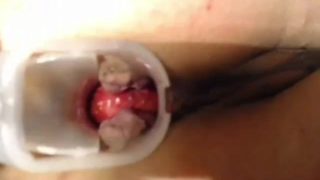 Another anal speculum